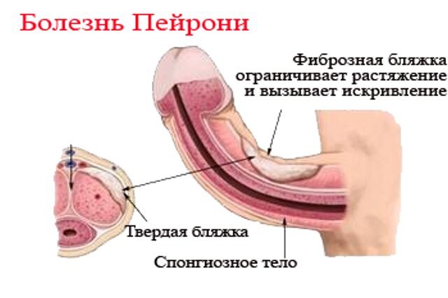 Как выпрямить член