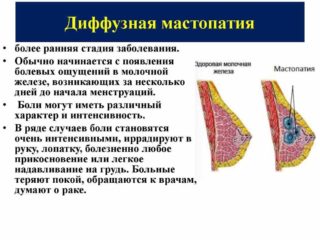 Код диагноза мкб мастопатия
