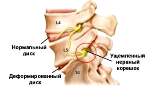 Что такое остеохондроз с корешковым синдромом