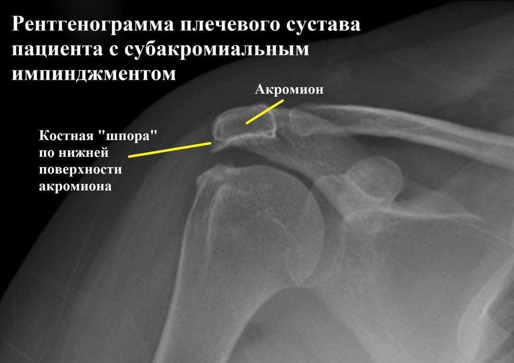 Импичмент синдром плечевого сустава это