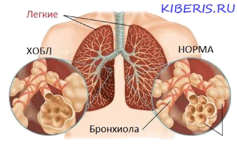 Хронические обструктивные заболевания легких