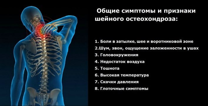Что такое остеохондроз с корешковым синдромом