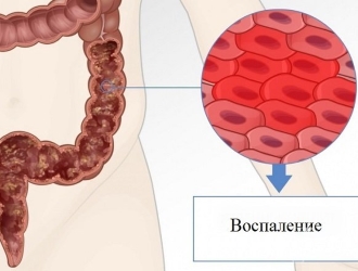 При спастическом колите меняется консистенция стула.