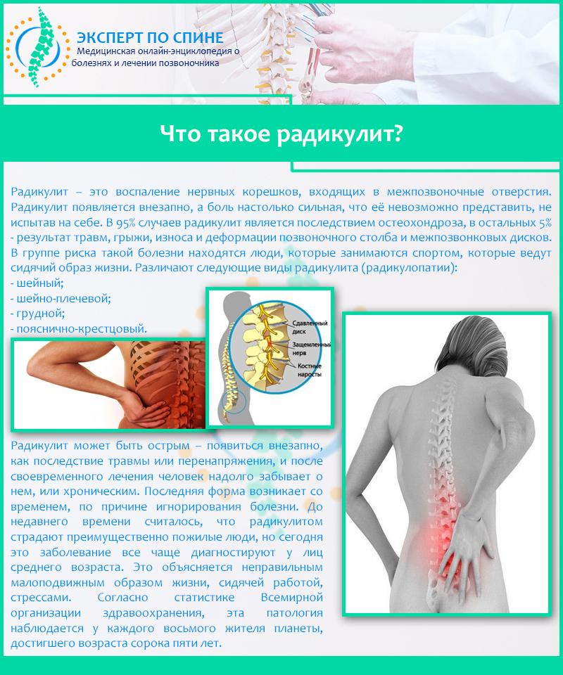 Что такое радикулит