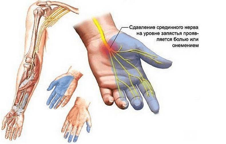 Эти 5 упражнений помогут при синдроме запястного канала Эти 5 упражнений помогут при синдроме запястного канала