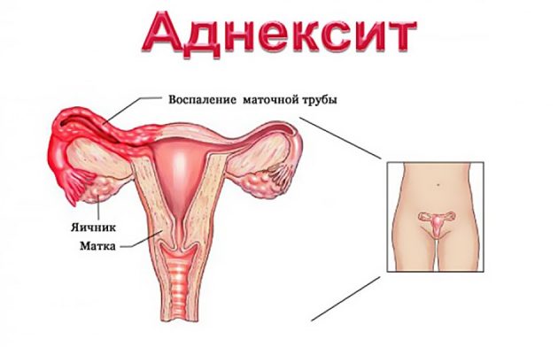 Хронический аднексит и беременность