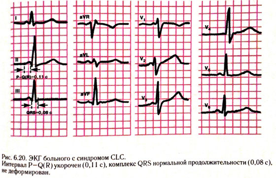 Синдром слс что это такое
