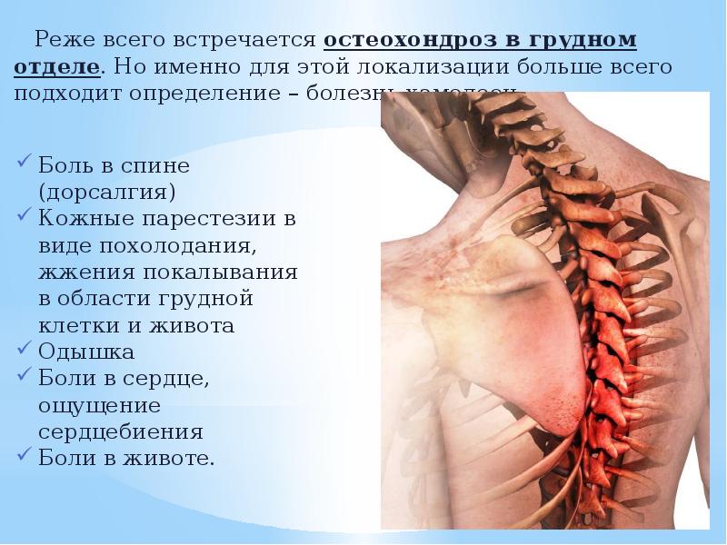 Что такое остеохондроз с корешковым синдромом