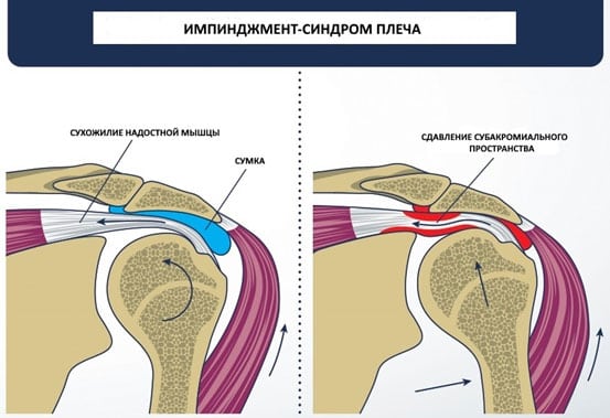 Импичмент синдром плечевого сустава это