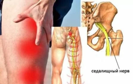 Симптомы ишиаса Боли при защемлении седалищного нерва