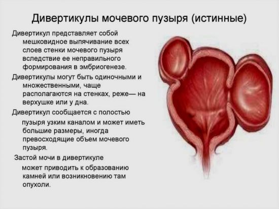 Дивертикулы мочевого пузыря
