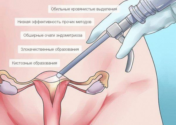 Показания для лапороскопии