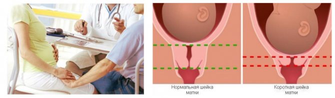 Прорезывание шва на шейке матки 8
