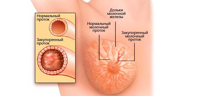расширенные протоки в молочных железах