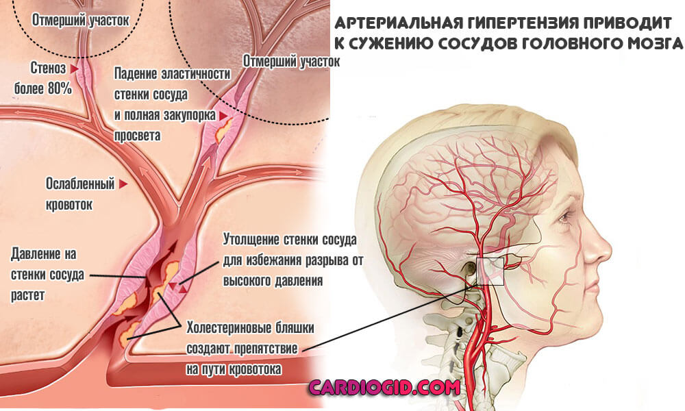 Дэ 2 степени с цефалгическим синдромом