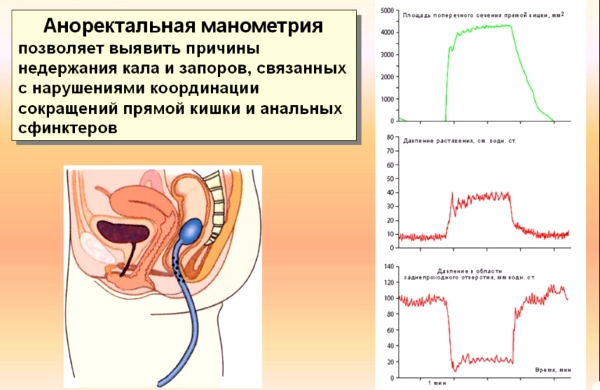 Анализ аноректальная манометрия.