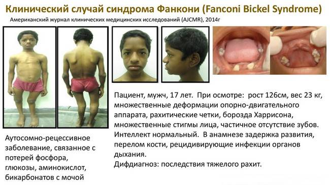 Симптомы синдрома Фанкони Симптомы синдрома Фанкони
