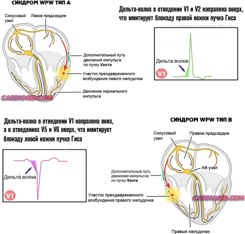 синдром-впв-тип-а-и-б