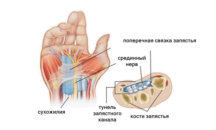Синдром запястного канала, тунельный синдром