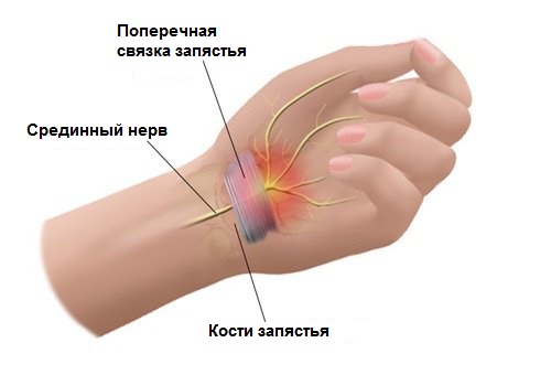 Туннельный синдром запястья Туннельный синдром запястья