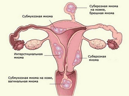 Виды миоматозного узла